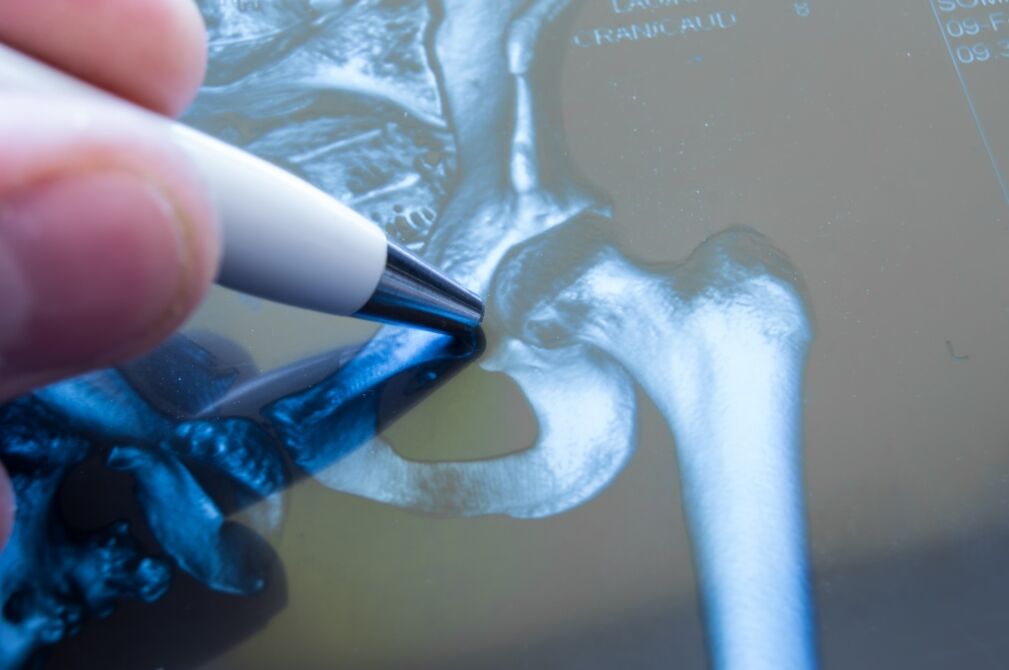 Артроз тазобедренного сустава на рентгенограмме